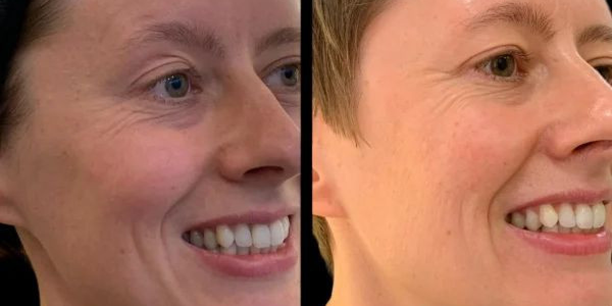 Does the Best Plastic Surgeon in Dubai Recommend Profhilo?